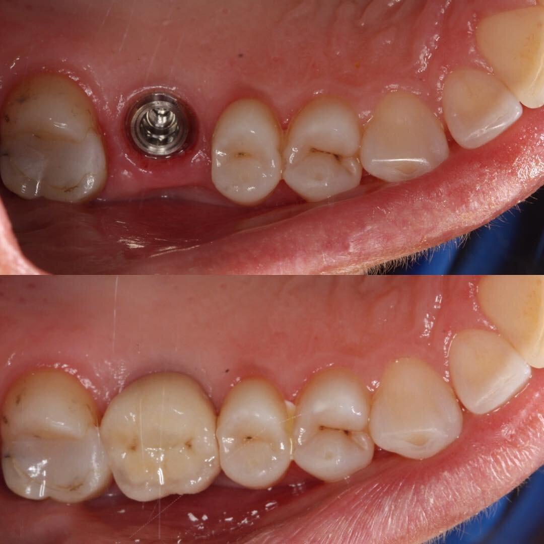 Implant replacement for molar