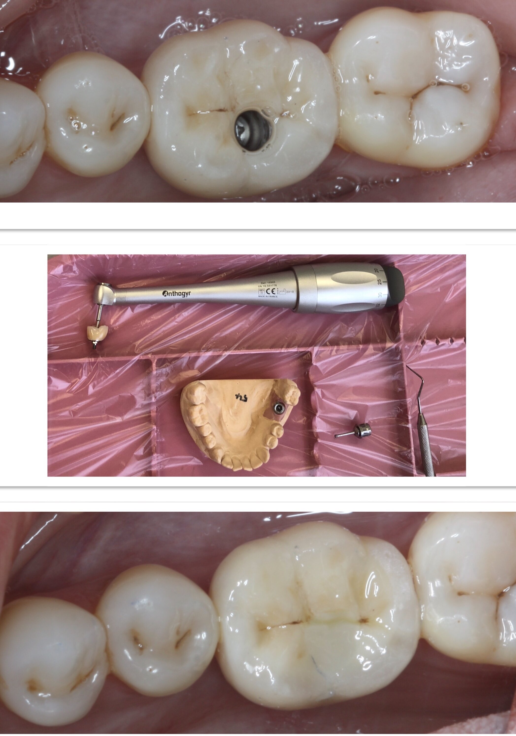 Implant replacement for molar tooth