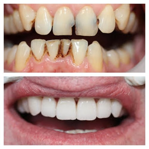 Male in 50's, teeth whitening, preventive care, and 6 porcelain crowns copy.jpg