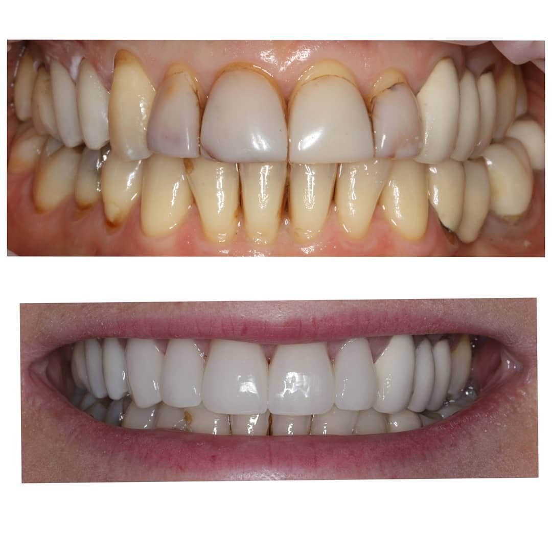 before and after 7 crowns, 15-22, wanted to retain bridge 13-15.jpg
