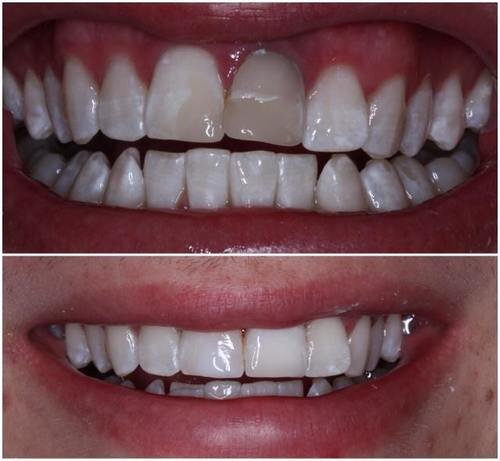 Crown for 18 year old male for central incisor after teeth whitening .jpeg