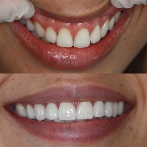 Porcelain crowns for young female in 20's requesting broader and perfect smile copy.jpeg