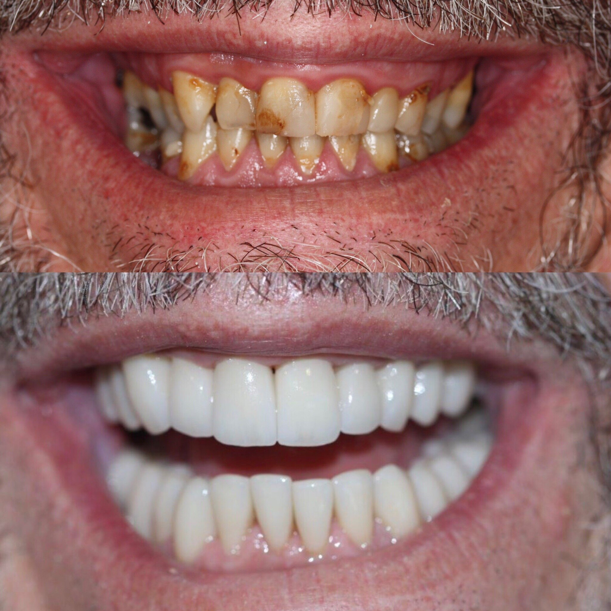 Full mouth rehabilitation male in 50's, request for natural but fresh appearance .jpg