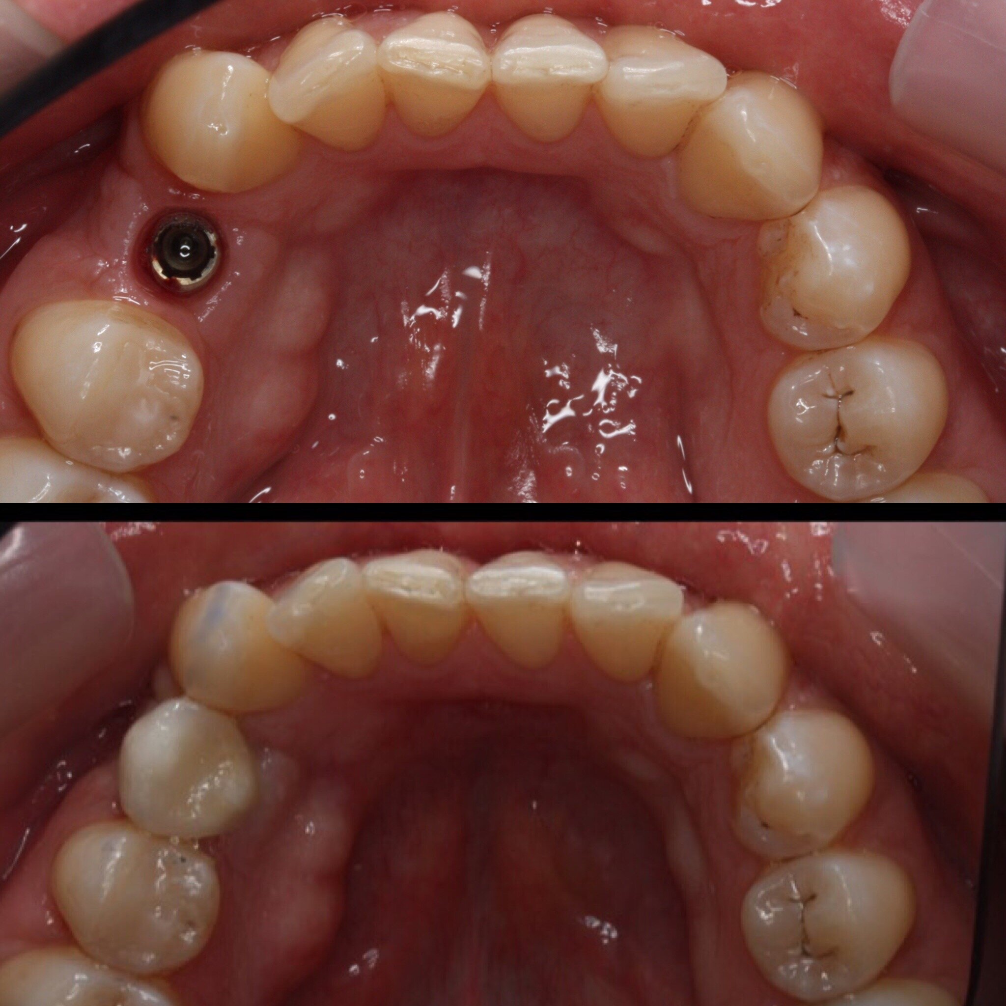 Implant lower premolar, F 30's,.jpg