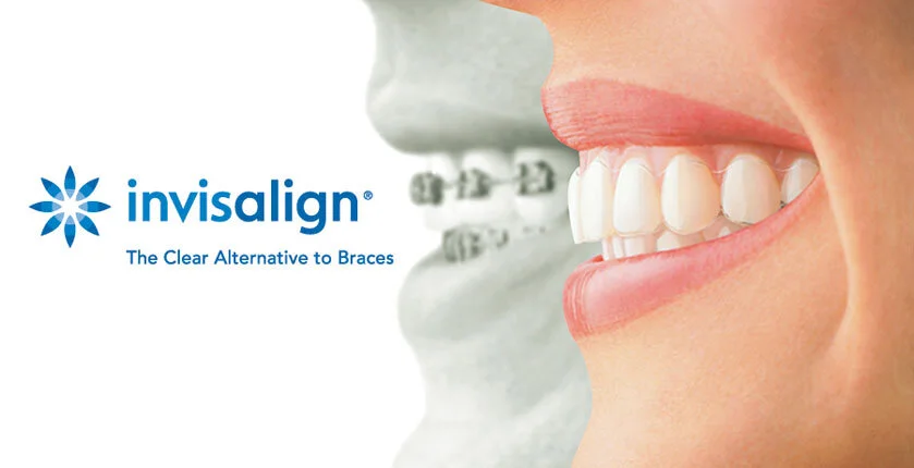 smile and a model with braces with words invisalign and the clear alternative to braces