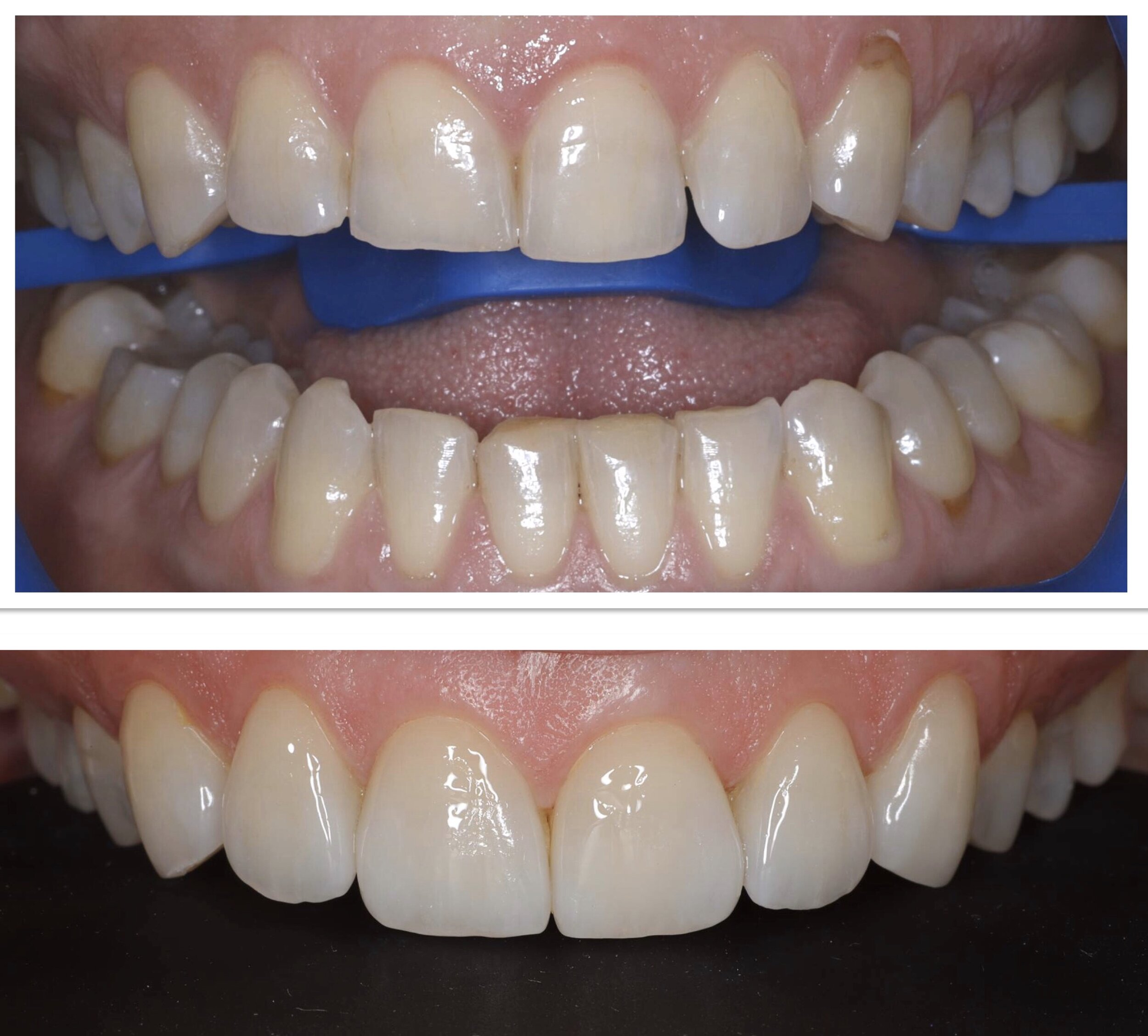 In office teeth whitening and porcelain veneers; female in 40's; Dr Leila Haywood and Christine Richards 2019