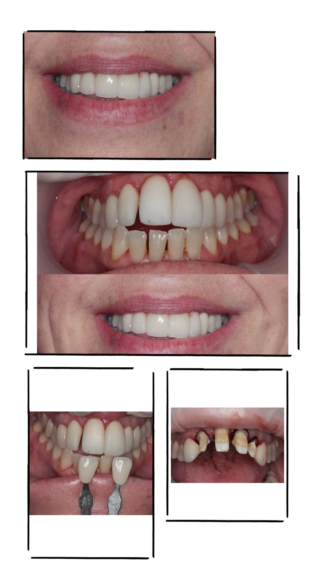 Dental Crowns at Brisbane Smile Boutique