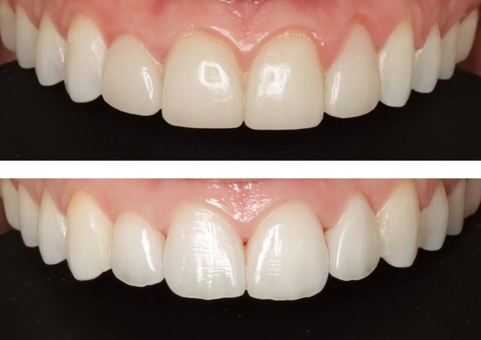 Porcelain Veneers