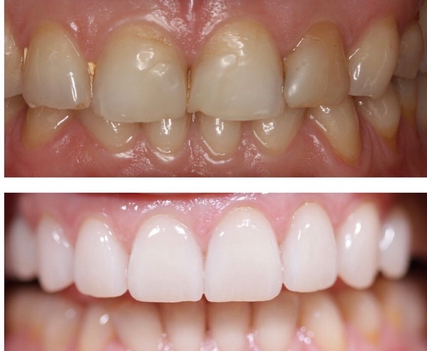 Porcelain Veneers for a perfect smile at Brisbane Smile Boutique Dentists