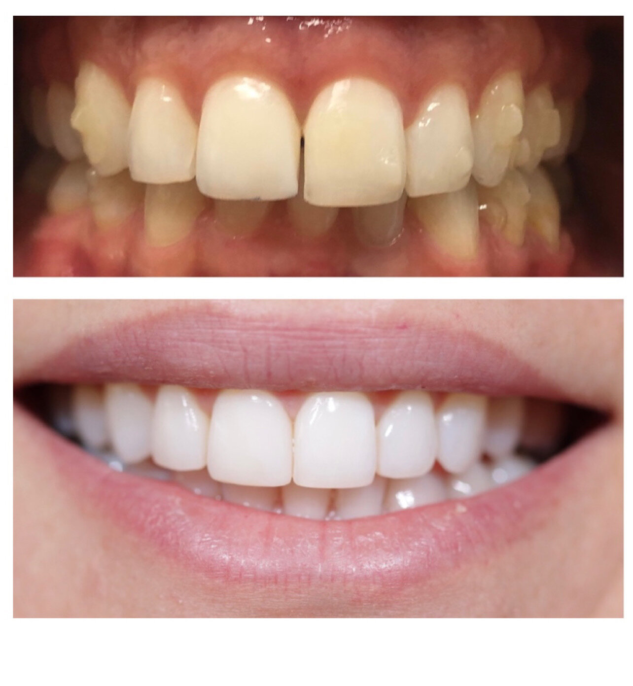 Invisalign followed by composite resin veneers