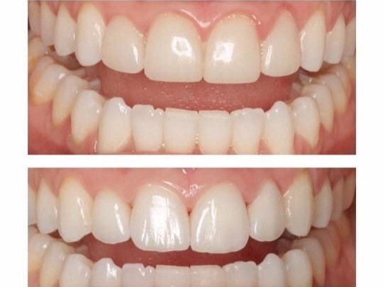 Porcelain Veneers