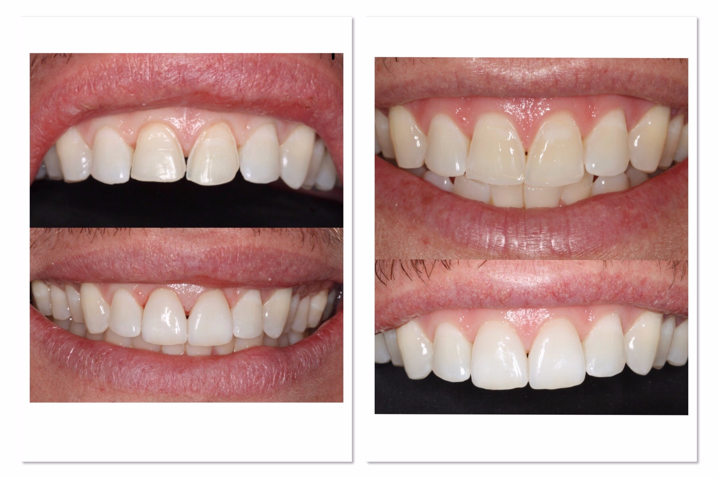 Porcelain Veneers Brisbane with before and after images of smile design by Dr Leila Haywood, an experienced Female Cosmetic Dentist in Spring Hill, Brisbane at Brisbane Smile Boutique 