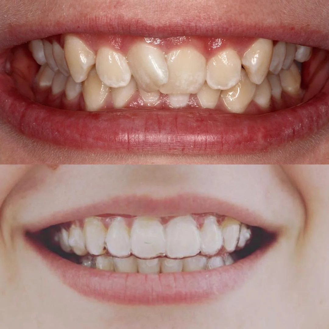 a woman with a misaligned smile before and then straight in the after photo at Brisbane Smile Boutique