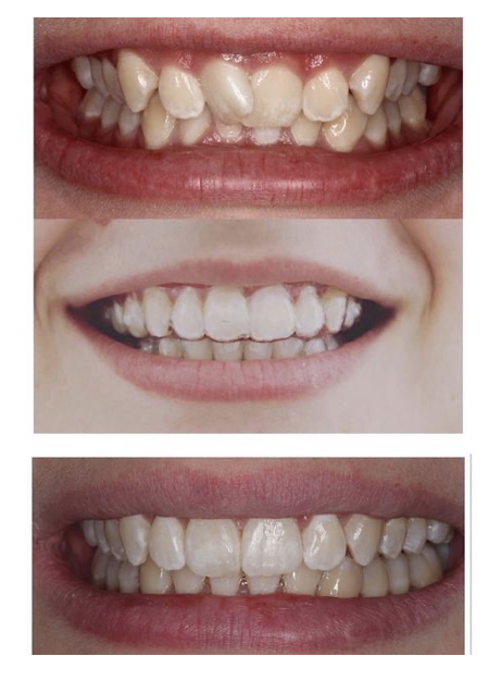 Inivsalign Dentist Brisbane.png