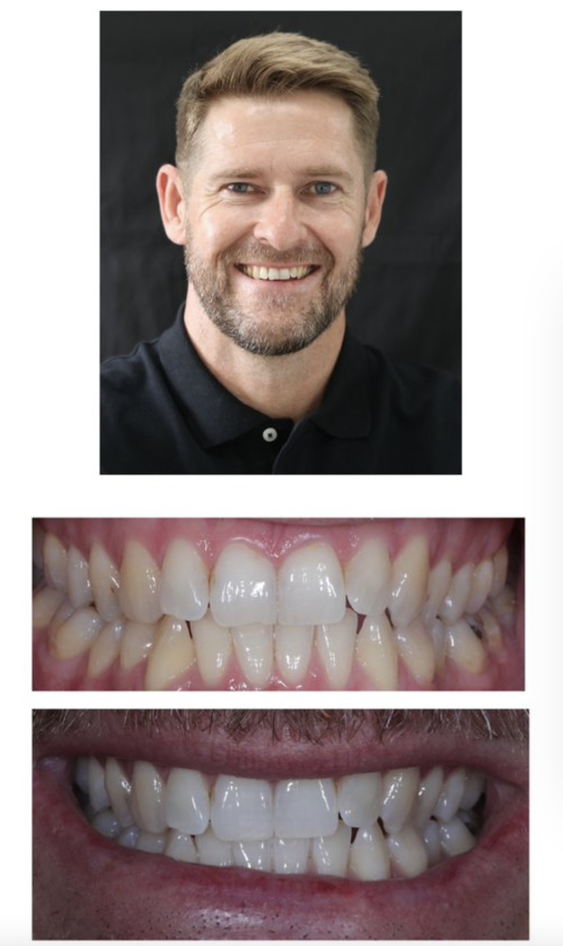 Teeth Whitening.png