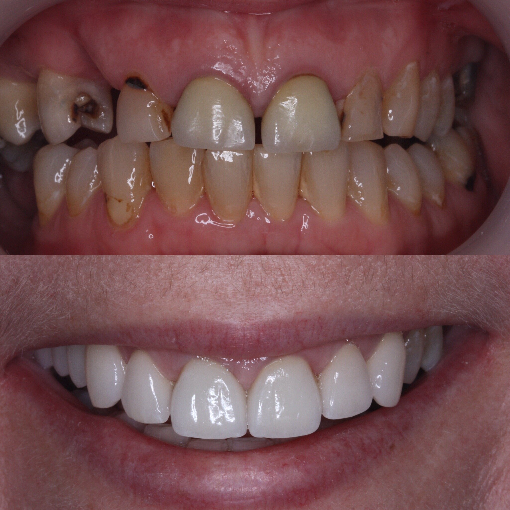 Smile Makeover with porcelain crowns and bridge work