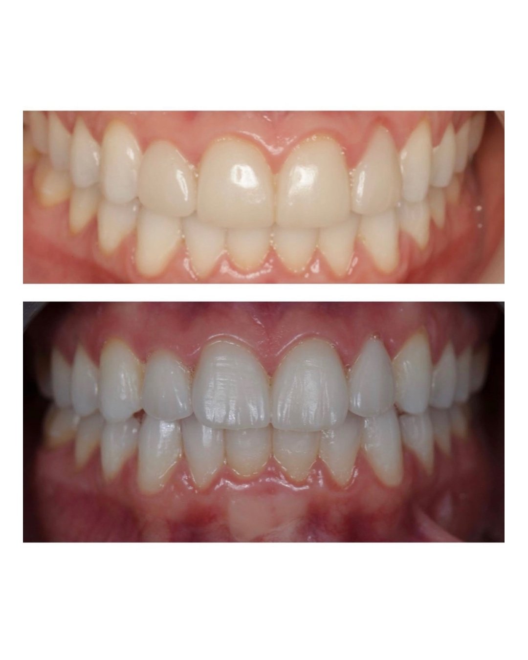 Porcelain Veneer Correction.jpg