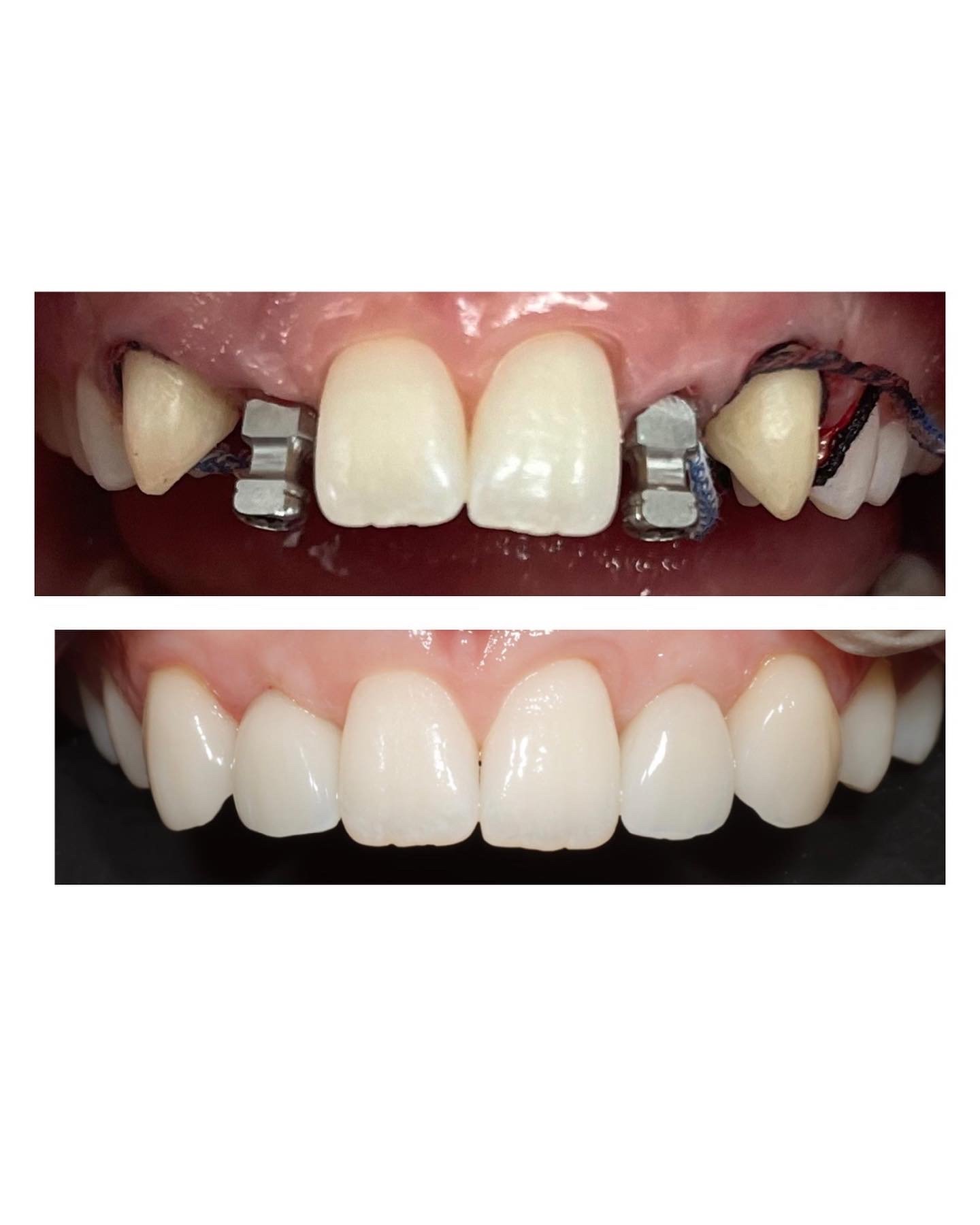 Dental Implants Brisbane.jpg