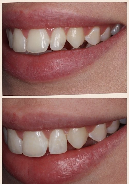 Young female tooth bonding on lateral incisor to create symmetry.jpeg