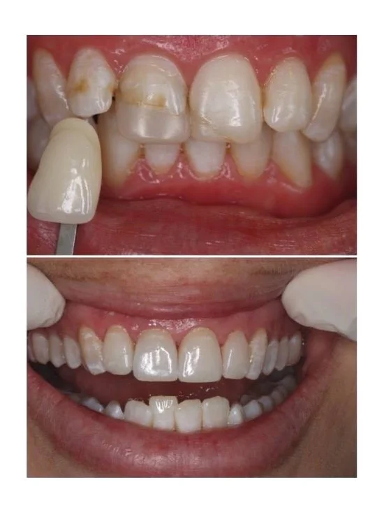 Porcelain Veneers Brisbane with before and after images of smile design by Dr Leila Haywood, an experienced Female Cosmetic Dentist in Spring Hill, Brisbane at Brisbane Smile Boutique 