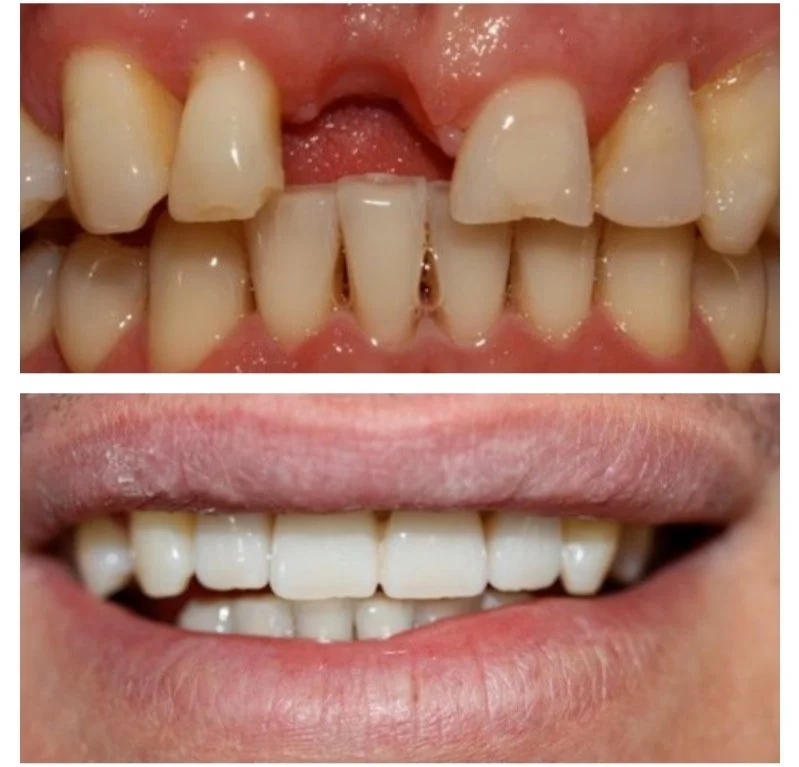 before and after photos at Brisbane Smile Boutique of a smile that has been restored with porcelain veneers, dental crowns and a dental bridge by Dr Leila Haywood, a female cosmetic dentist