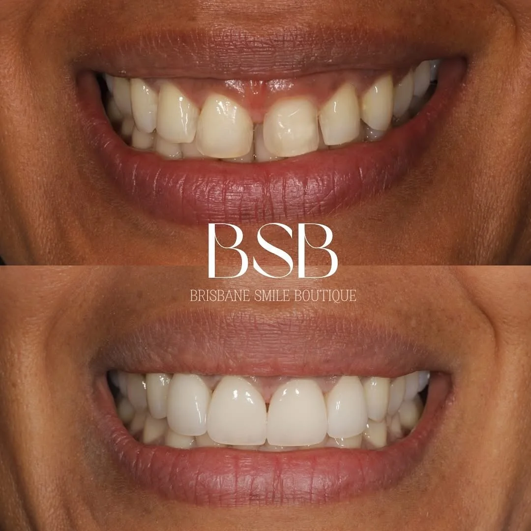 Brisbane Dentist Smile Makeover