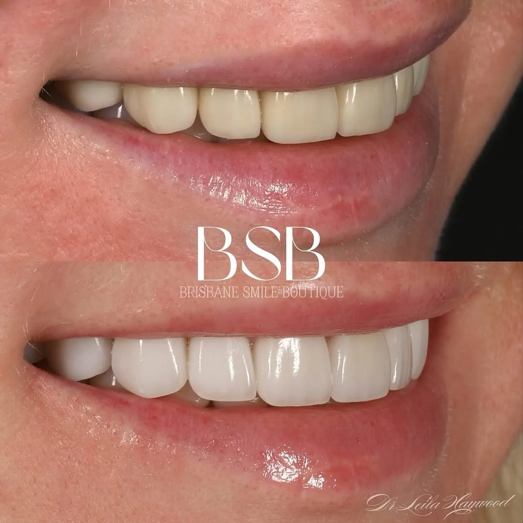 Porcelain Veneers Brisbane