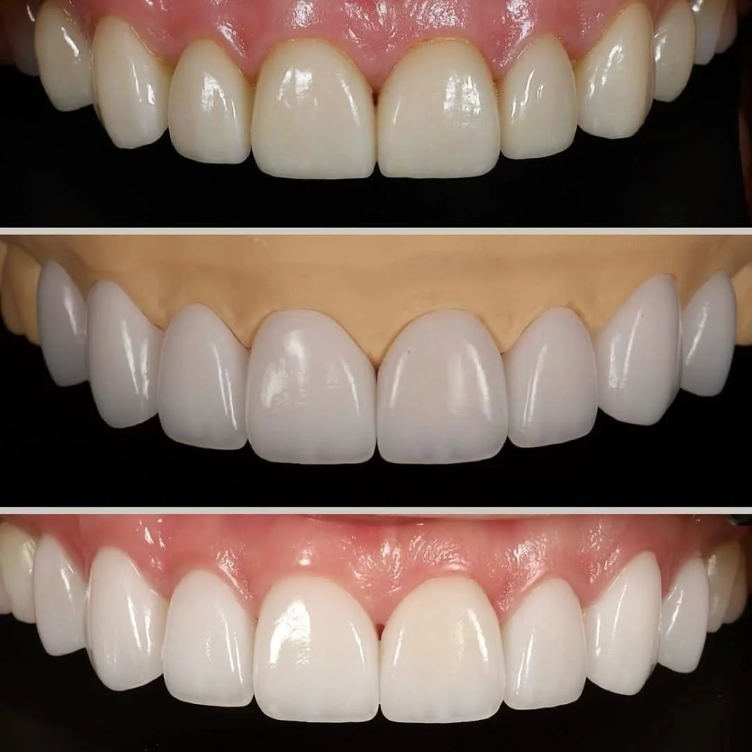 Veneers Brisbane