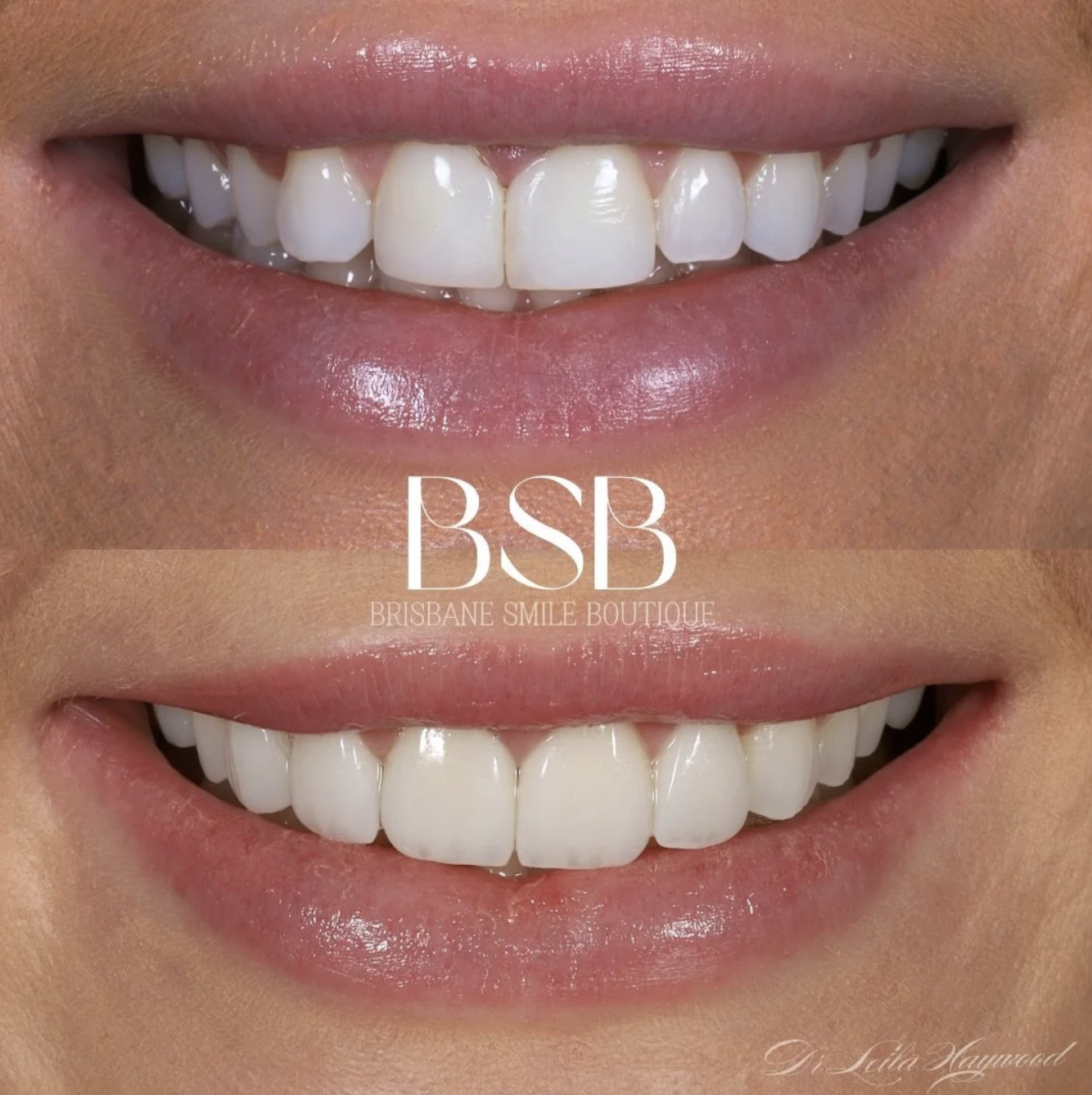 before and after image of porcelain veneer smiles