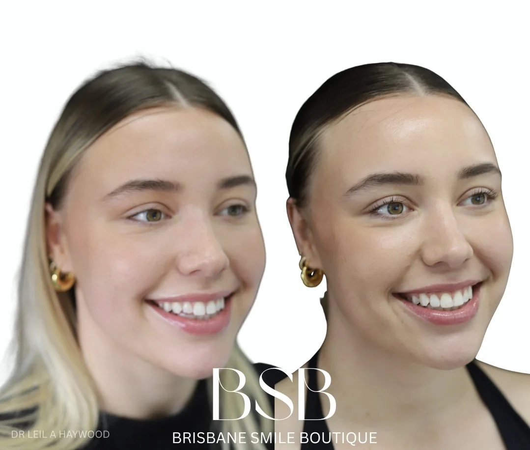 Before and after photos of a stunning young woman smiling at the dentist after a smile tranformation with Dr Leila Haywood at Brisbane Smile Boutique