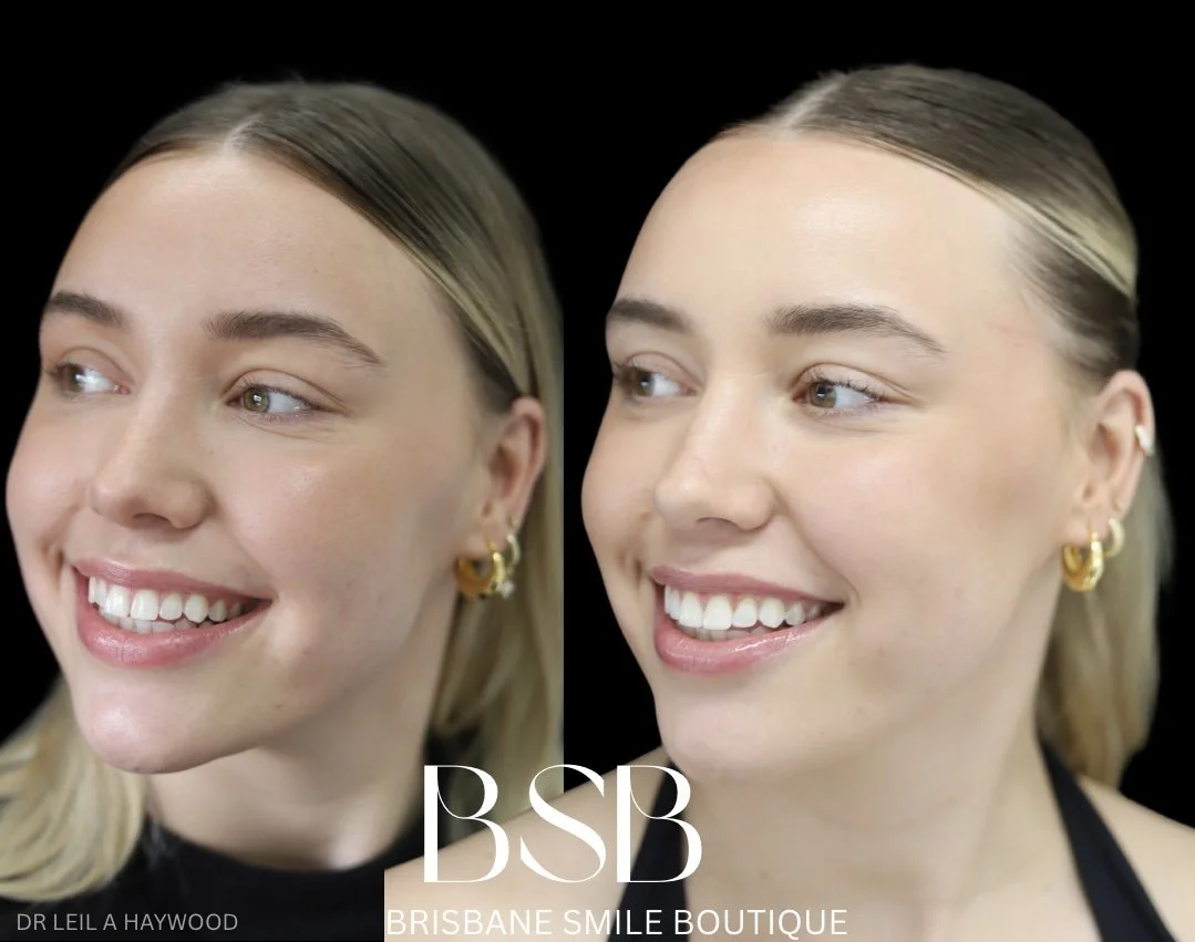 before and after images of beautiful woman smiling at the dentist after a smile tranformation with Dr Leila Haywood at Brisbane Smile Boutique