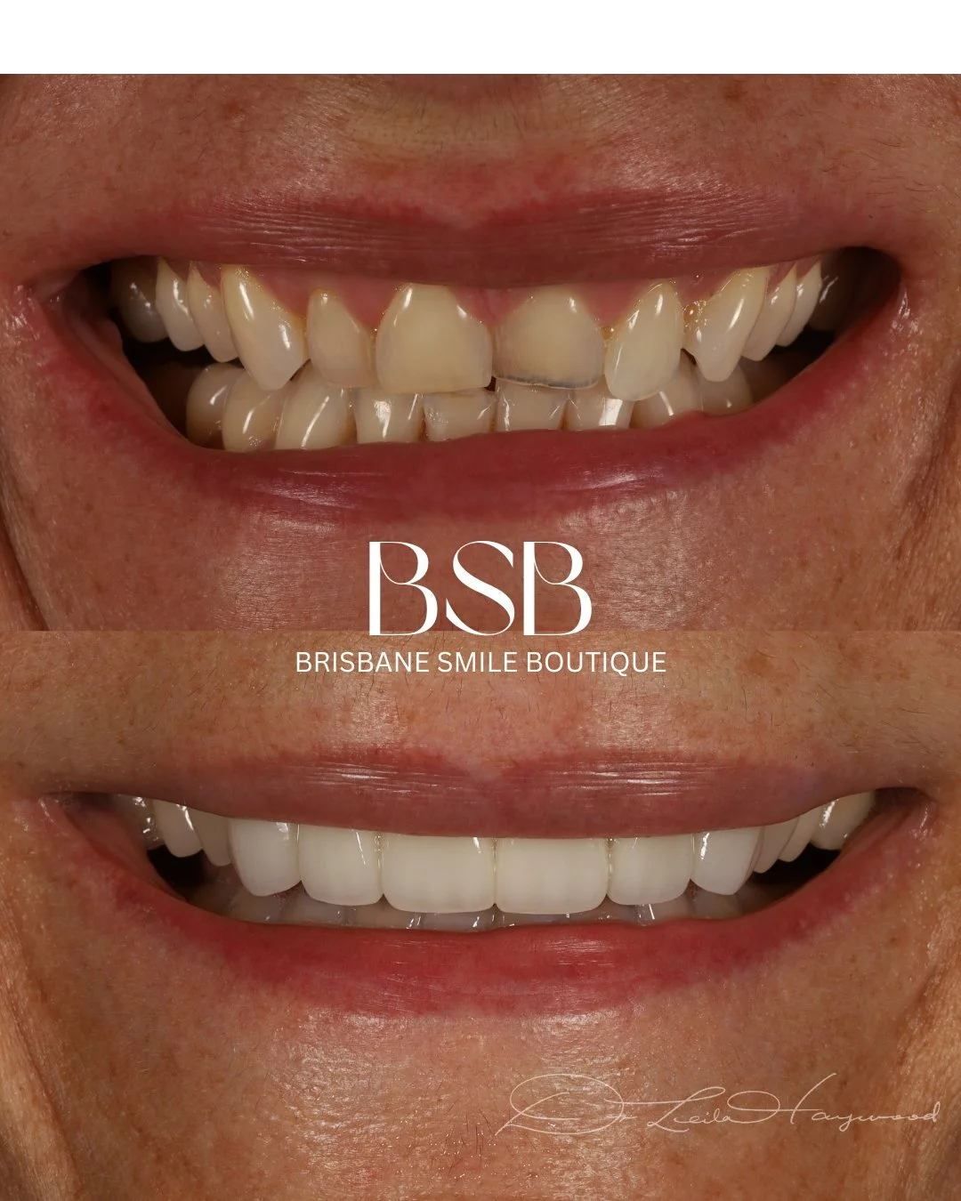 Porcelain Veneers Brisbane before and after images of an older female smile with Dr  Leila Haywood at Brisbane Smile Boutique, one of Brisbane's most accomplished female aesthetic dentists in Spring Hill, in inner city Brisbane