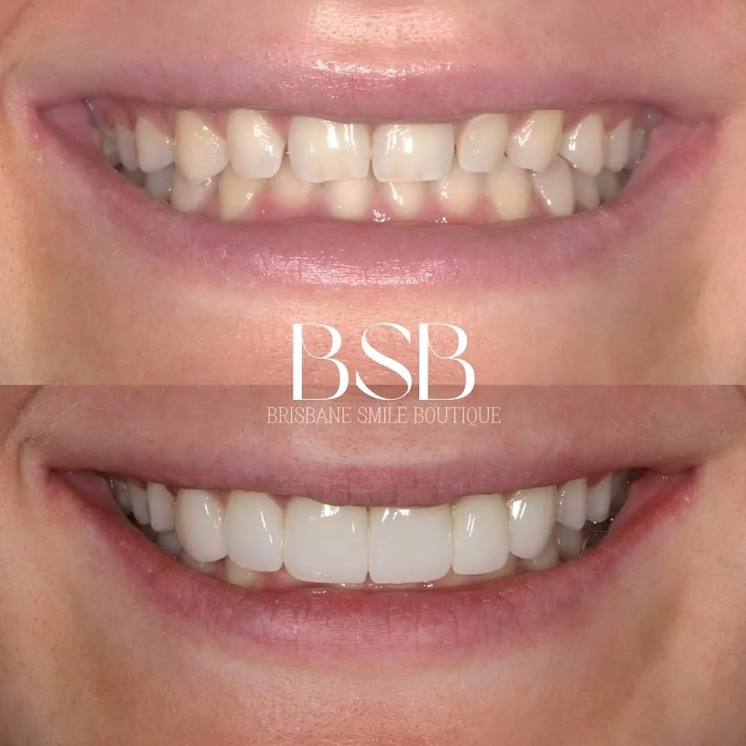 A before and after image of cosmetic dentistry treatment with ultra thin veneers by leading female cosmetic dentist, Dr Leila Haywood at Brisbane Smile Boutique