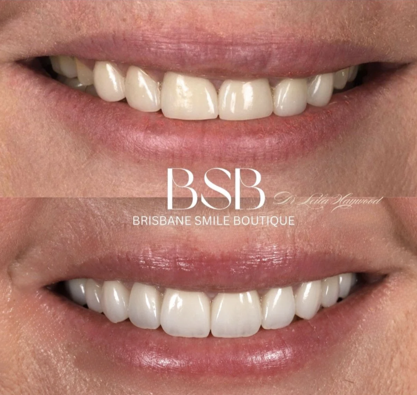 Before and after images of Full Smile Transformation in Brisbane with Dr Leila Haywood, a female aesthetic dentist