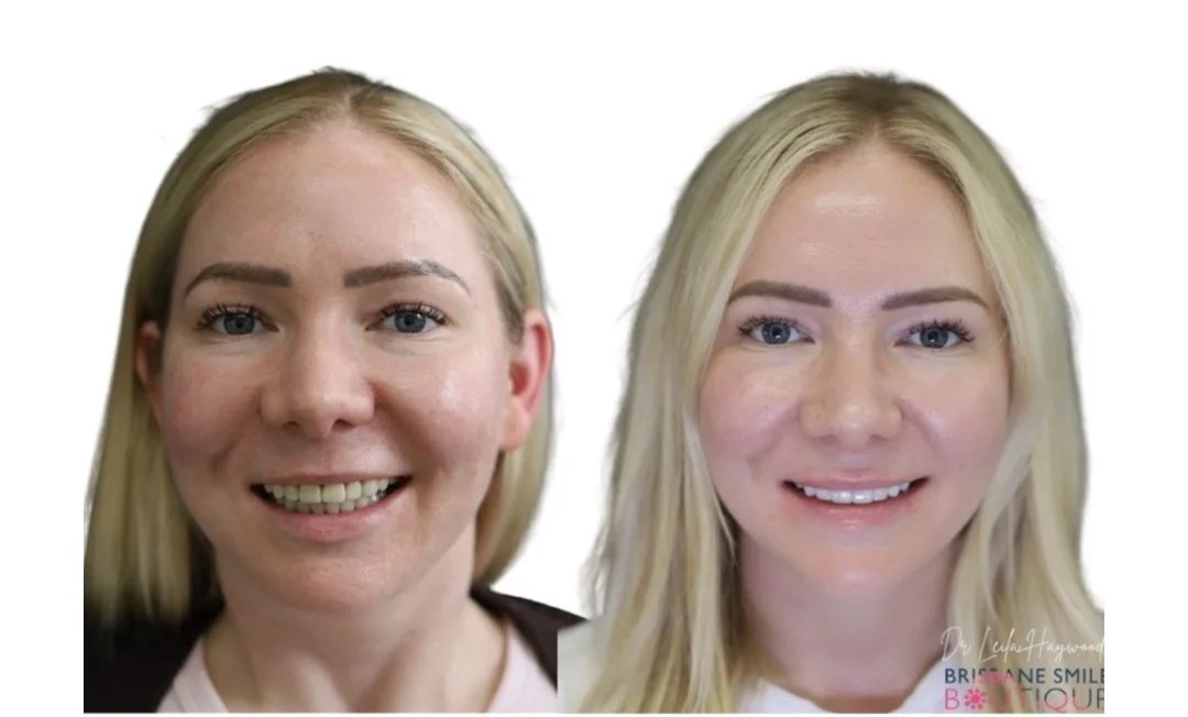 Comparison of two women with blonde hair, one before and one after a dental beautification procedure, showing improved smile and teeth enhancement.
