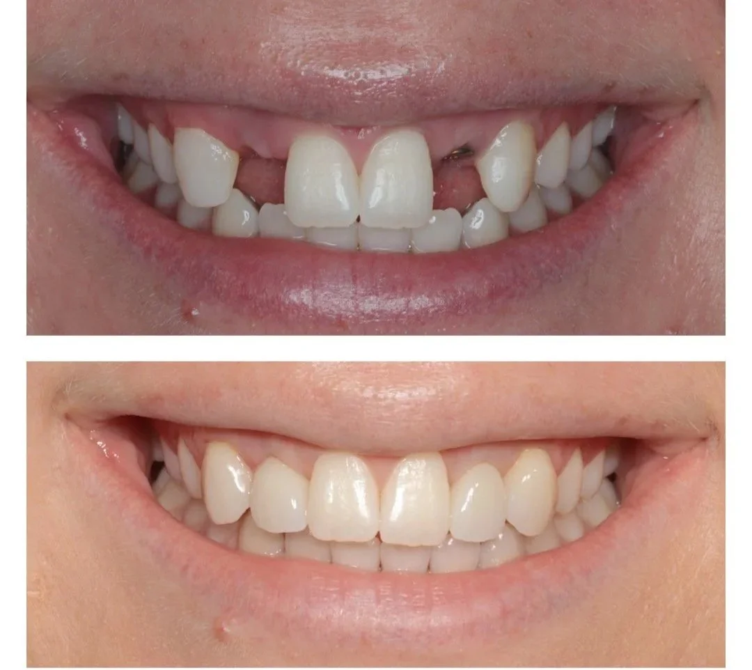 Dental+implant+Brisbane.jpg