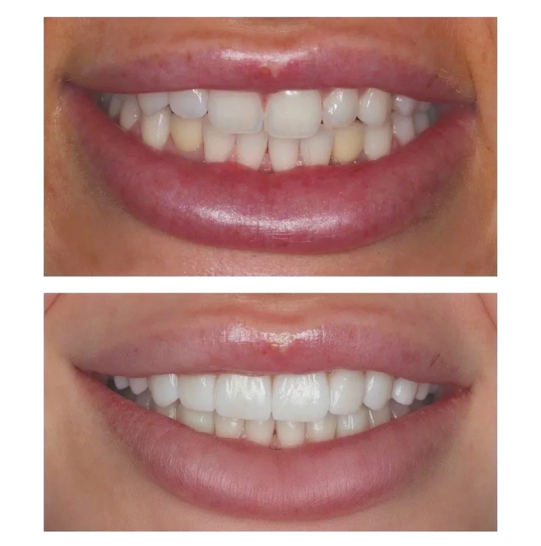 Before and after images of a smile makeover with porcelain veneers, teeth whitening and dental implants for a woman at Brisbane Smile Boutique 