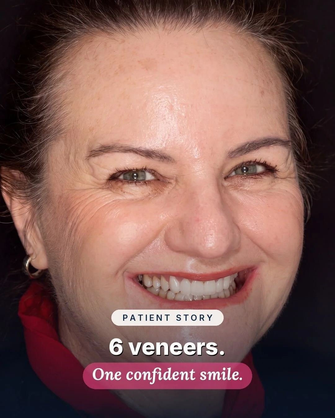 This patient came to me wanting to refresh six older porcelain veneers and create a more harmonious smile.

Before replacing the veneers, we first straightened the lower teeth and refined the bite, creating a more considered foundation for the restor