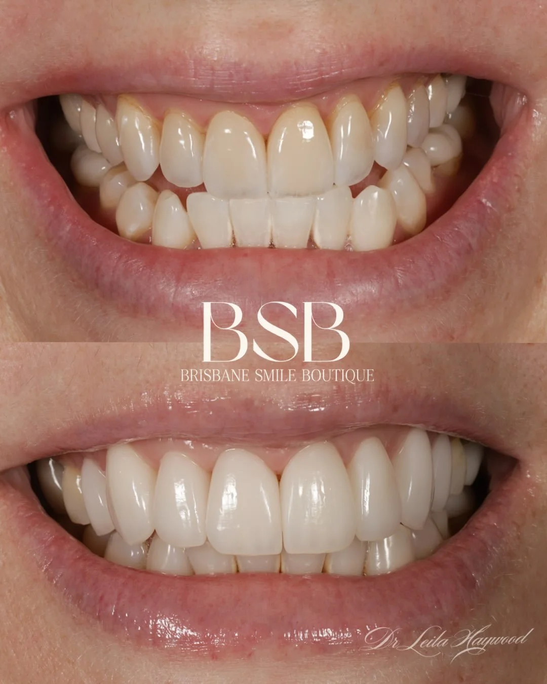 A refined smile refresh, designed to preserve what she already loved!

Patient had porcelain veneers from teeth 14&ndash;24 placed approximately 10 years ago. She was happy with the existing shape, form and overall proportions, but wanted a brighter 