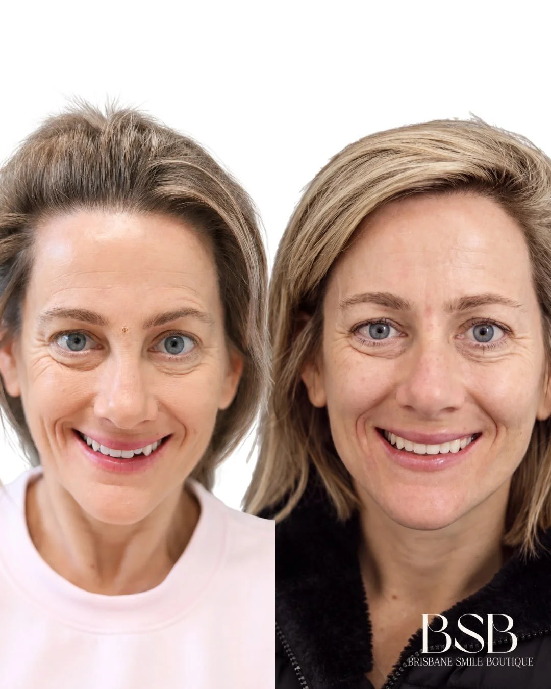 Composite resin bonding case after Invisalign.

Alignment first, then a delicate refinement of shape and incisal edge. The composite is built onto the tooth &mdash; nothing is filed away.

Individual results vary.
All treatment is individually planne