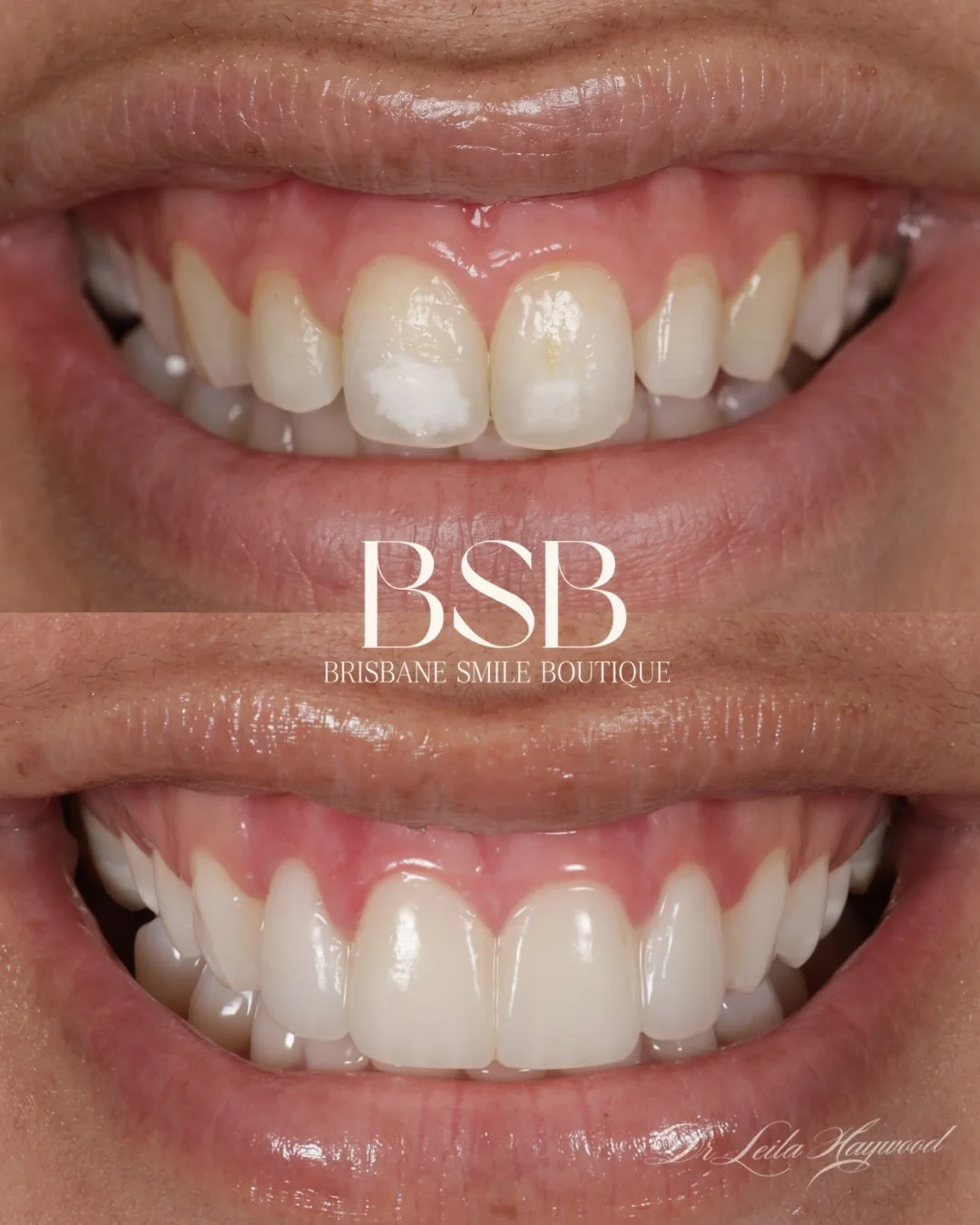 Four porcelain veneers, planned and placed by Dr Leila Haywood at Brisbane Smile Boutique.
With a case this small, most of the thinking goes into the teeth either side. Shade, contour and surface texture are matched to what is already there, so the v
