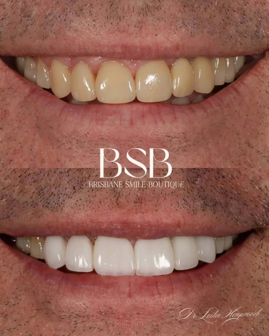 A considered refinement of the upper smile.

Four existing porcelain veneers were replaced, refining shape and shade across the upper front teeth. Two missing teeth on the upper left were restored with an implant-supported bridge, bringing quiet cont