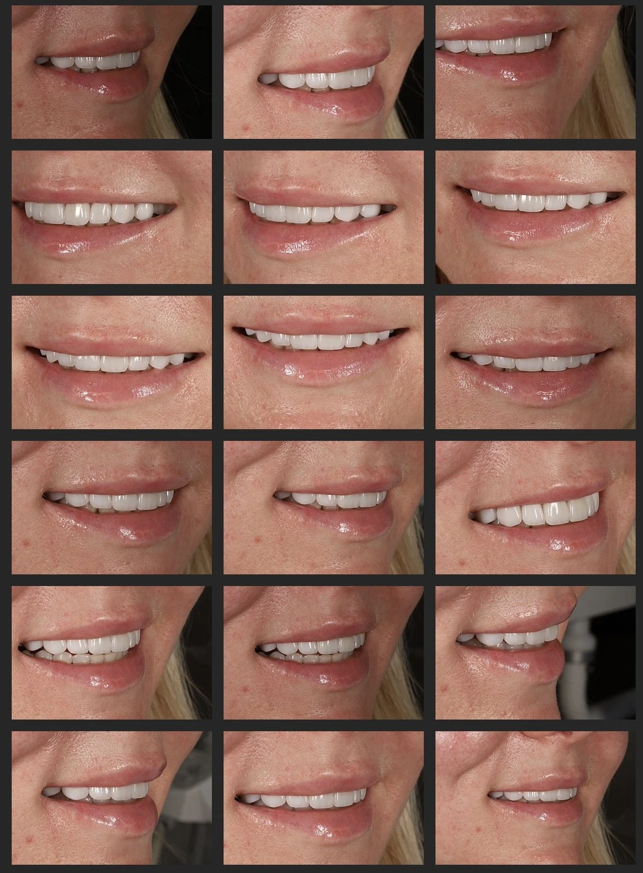 multiple images of a porcelain veneer case by Dr Leila Haywood, a cosmetic dentist in Brisbane with many photos of a women smiling, at Brisbane Smile Boutique' 