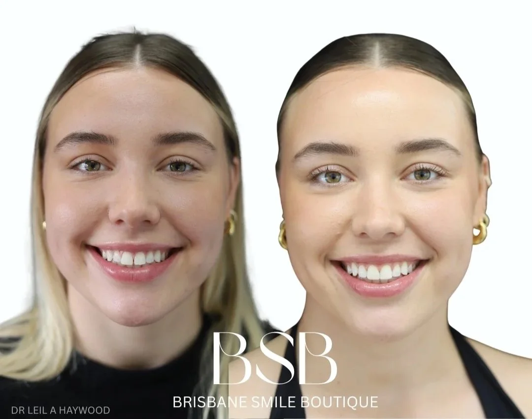 Before and after photos of a beautiful young woman after Composite Resin Veneers Brisbane Smile Boutique with Dr Leila Haywood, one of Brisbane's best female cosmetic Dentists in Spring Hill, in inner city Brisbane