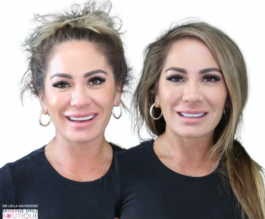 The same smiling woman with light skin, firstly with curly blond hair in a messy bun and secondly with straight light brown hair, both wearing hoop earrings and black tops, posing against a plain white background to showcase her dental makeover.
