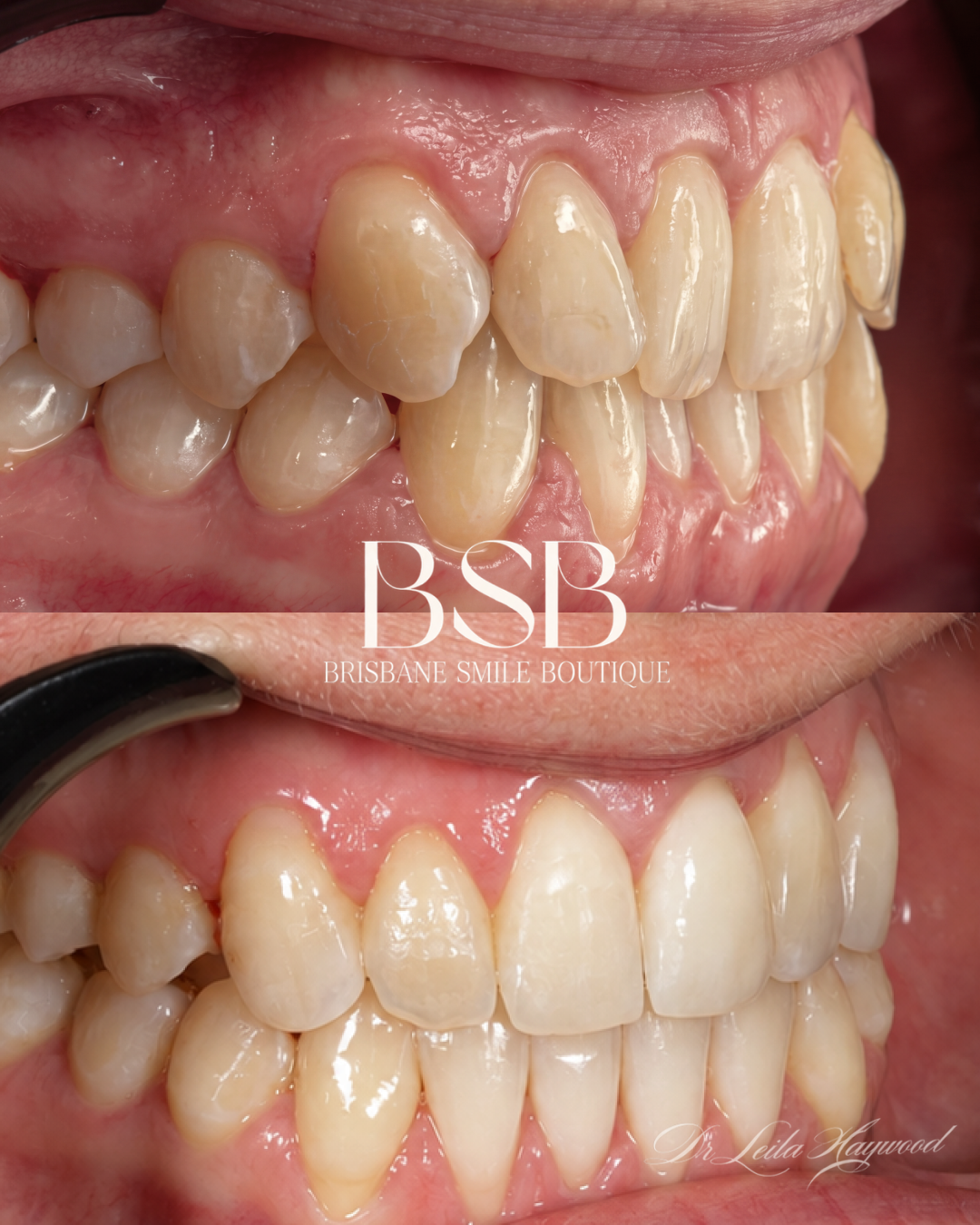Before and after image of invisalign dental treatment followied by conservative composite resin bonding