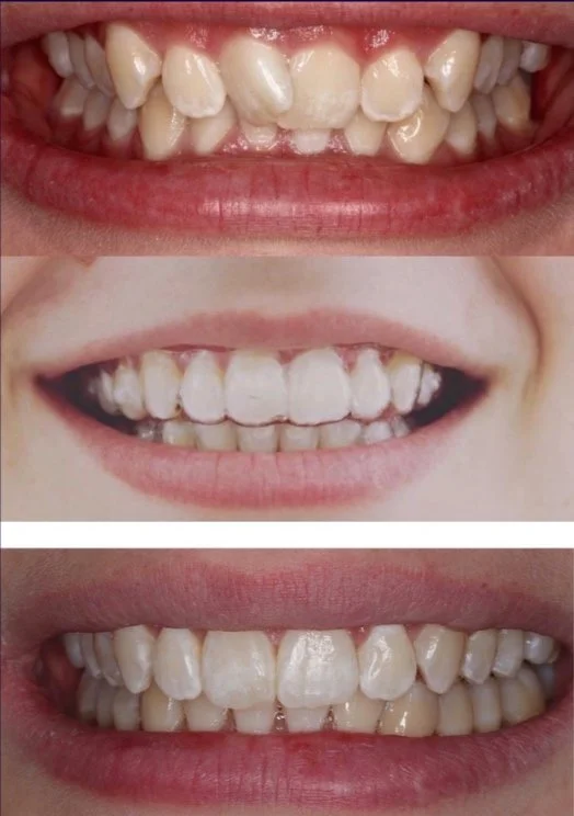before and after invisalign aligner treatment to straighten a woman's smile at Brisbane Smile Boutique Dentists in Spring with Dr Leila Haywood, one of Brisbane's most accomplished female cosmetic dentists
