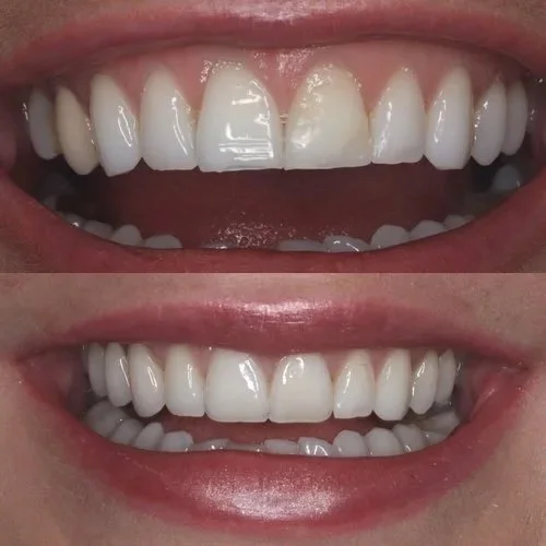 before and after photos at Brisbane Smile Boutique of a smile that has been restored with porcelain veneers, dental crowns and a dental bridge