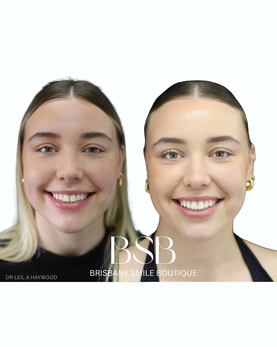 before and after dentistry images of a female patient who has had composite resin veneers and bonding at Brisbane Smile Boutique with Dr Leila Haywood, an experienced female cosmetic dentist in Spring Hill, Brisbane