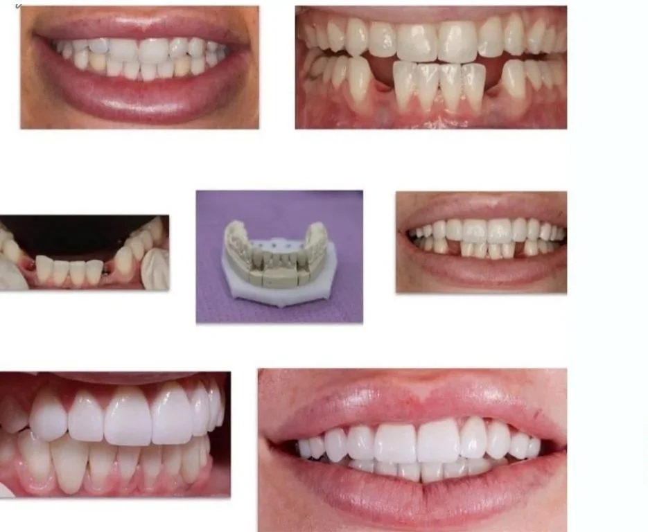 Sequence of images showing teeth before, during, and after dental treatment, including dental moulds for full smile rehabilitation and dental implant planning.